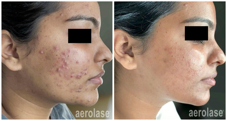 Neoderm by Aerolase