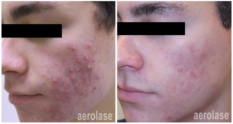 Neoderm by Aerolase