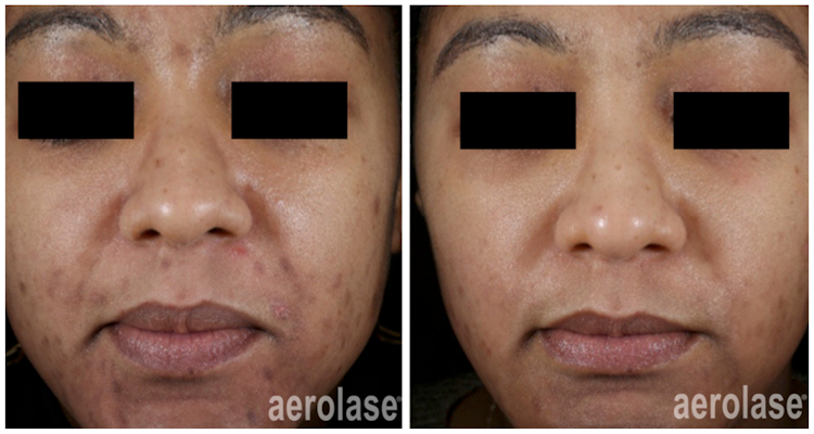 Neoderm by Aerolase