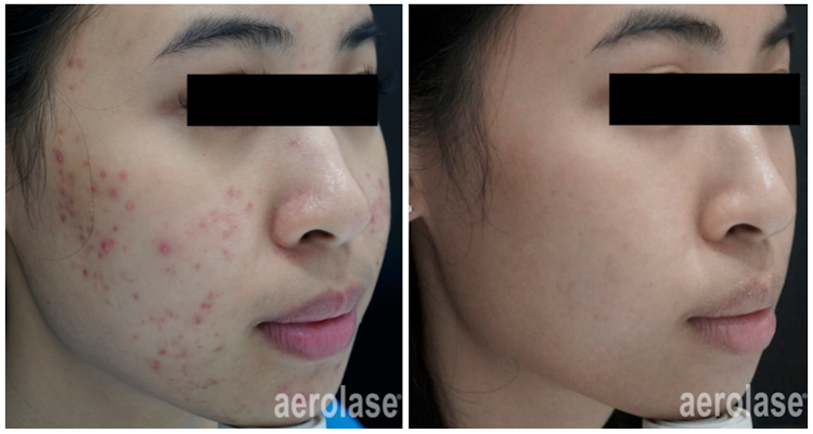 Neoderm by Aerolase