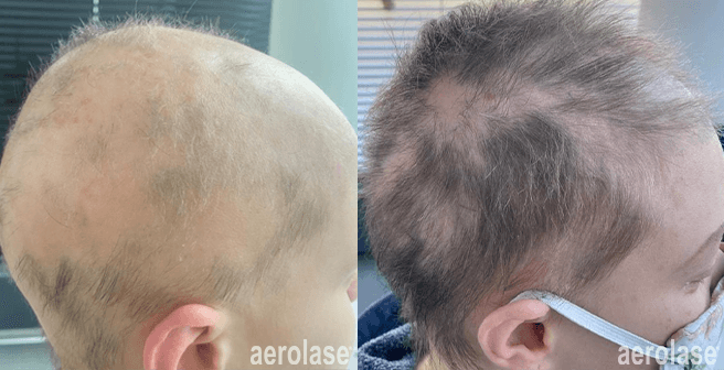 Alopecia Areata