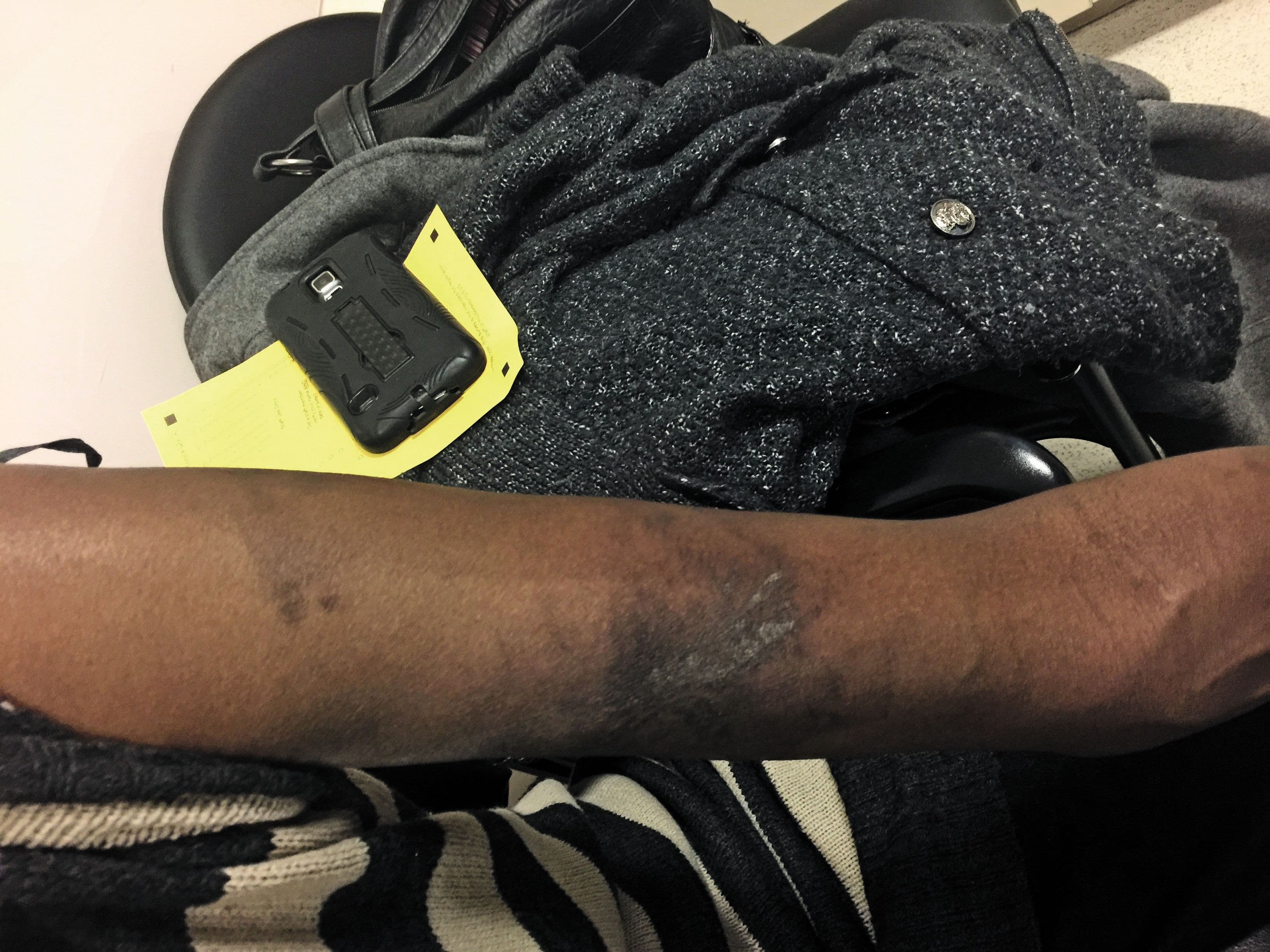 hyperpigmentation on arm