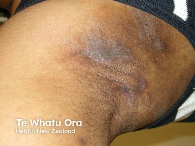 Patient with HS | Image Credit: © dermnetnz.org