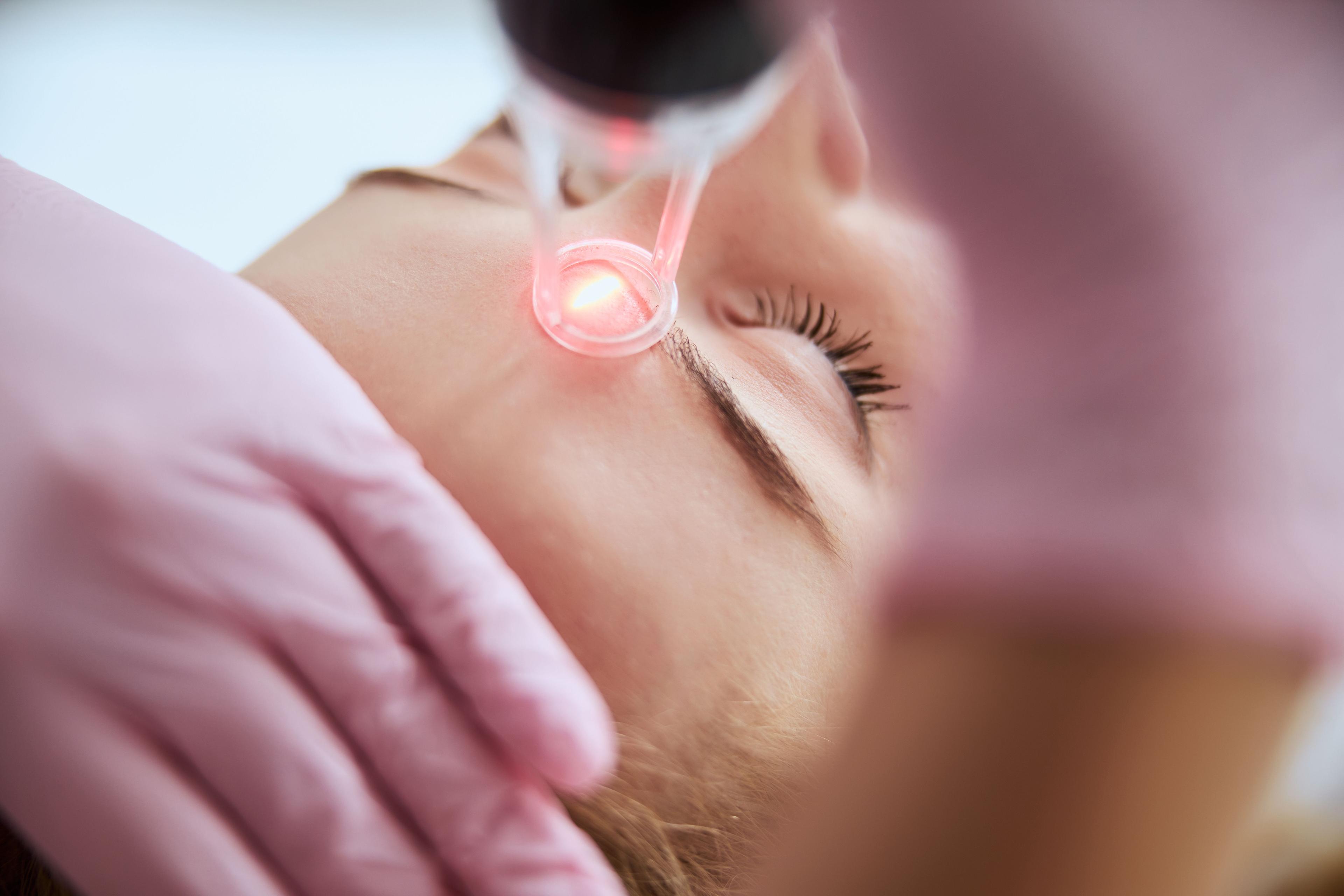 Advanced Laser Eases Acne Scars, Melasma, and Wrinkles