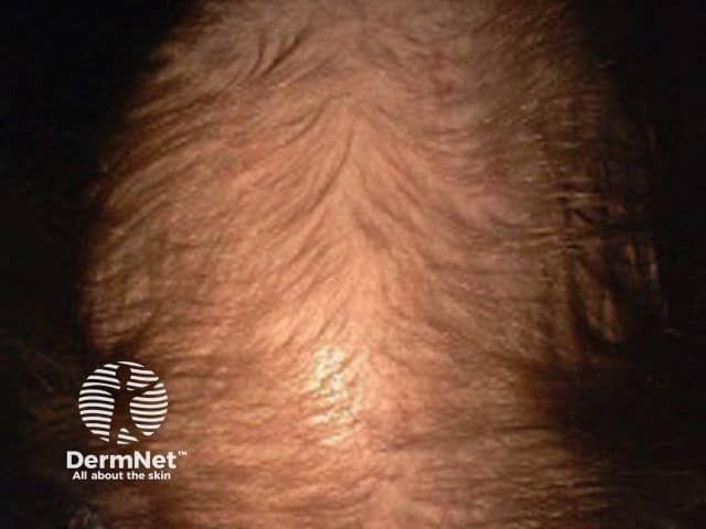 Grade 5 female pattern hair loss | Image credit: © DermNet