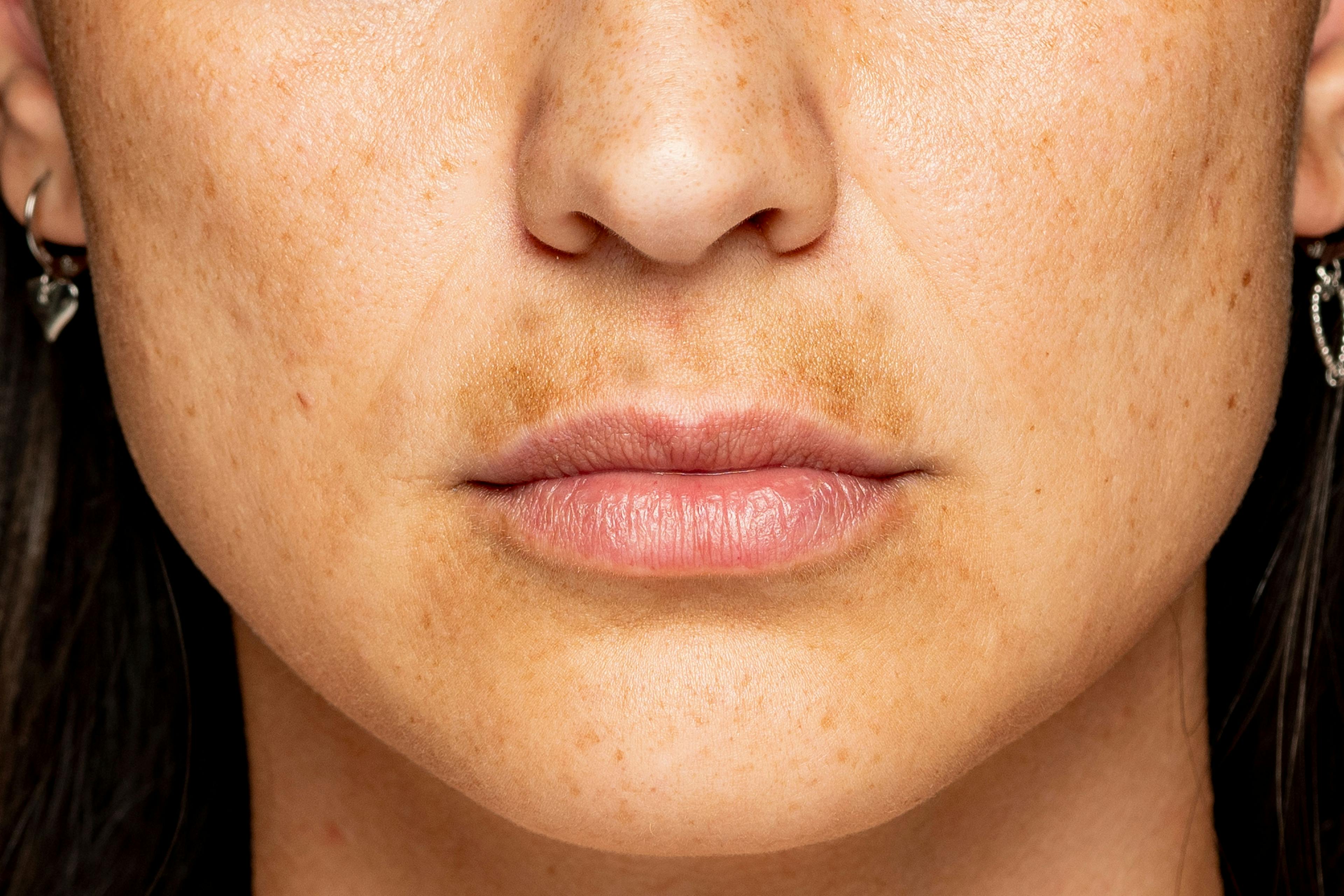 Woman with hyperpigmentation on the upper lip area