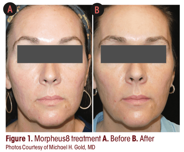 microneedling