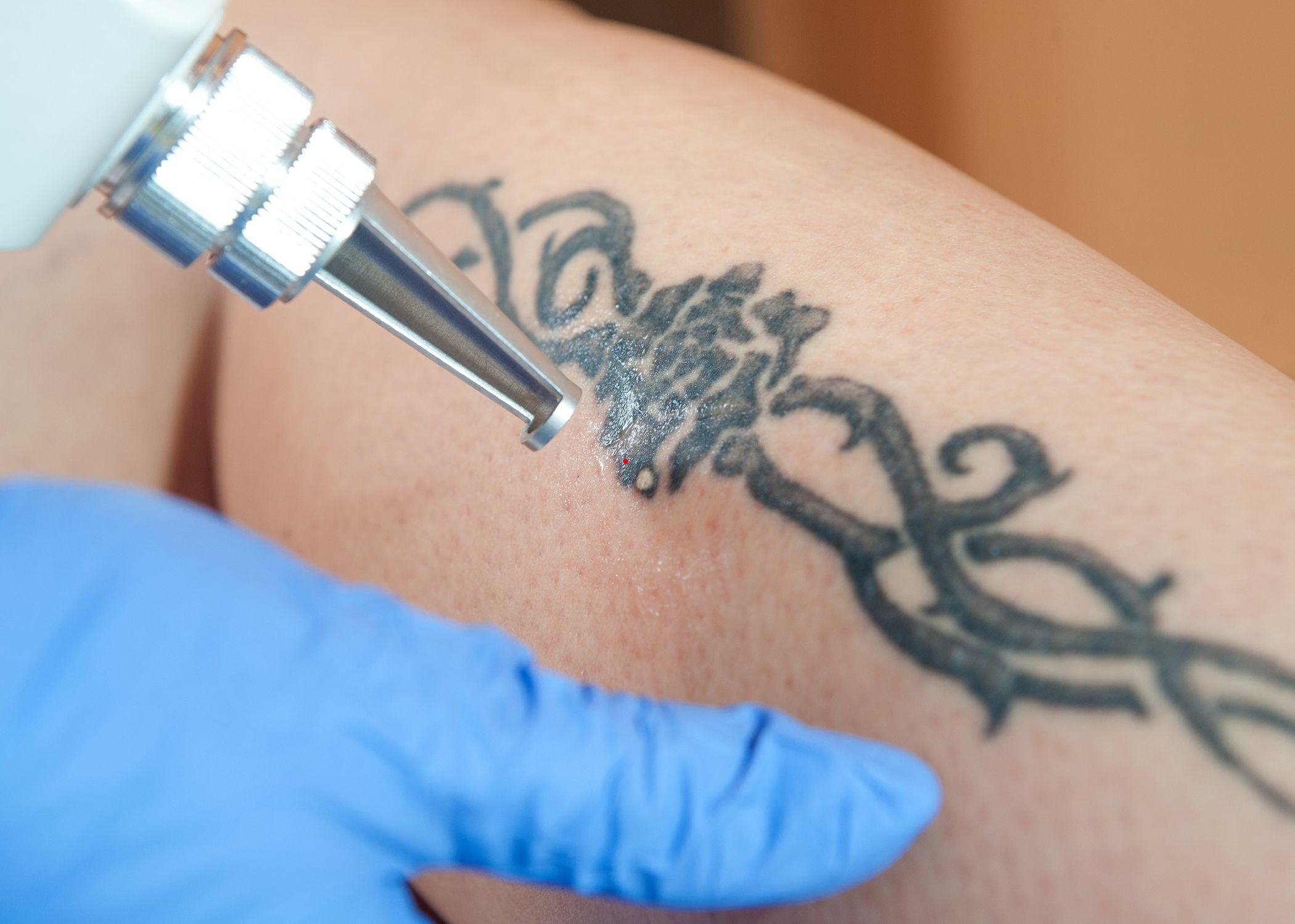 laser tattoo removal