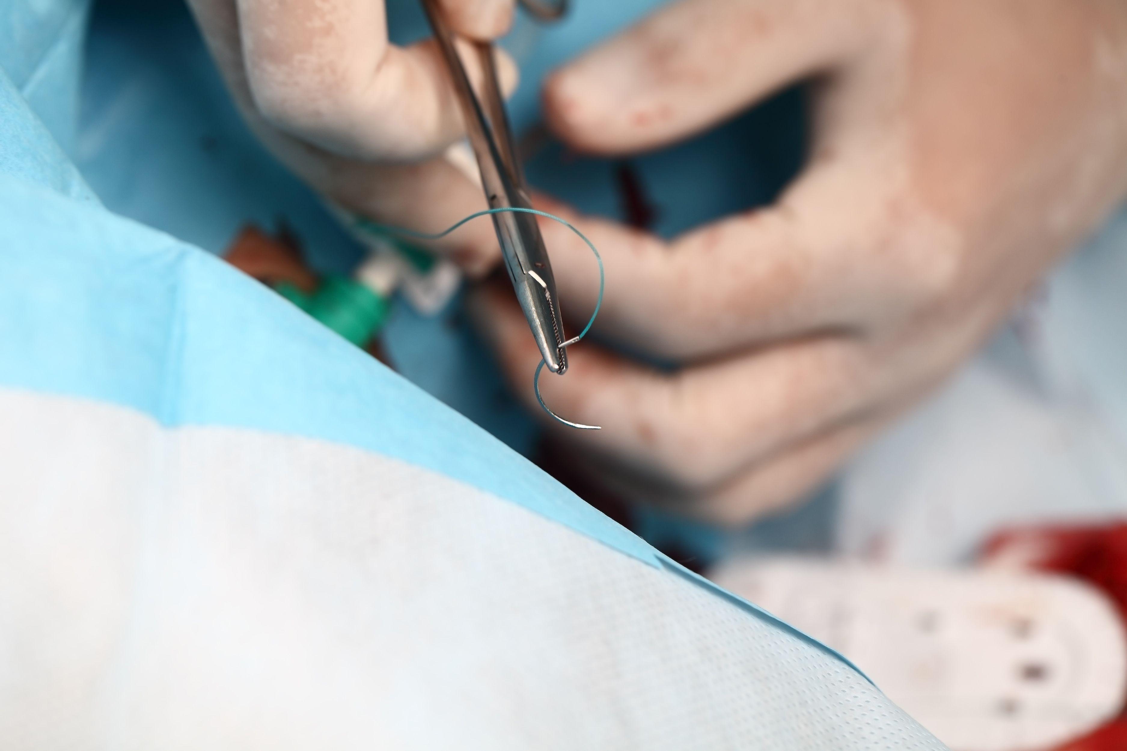 Physician prepares to make a stitch after surgical procedure