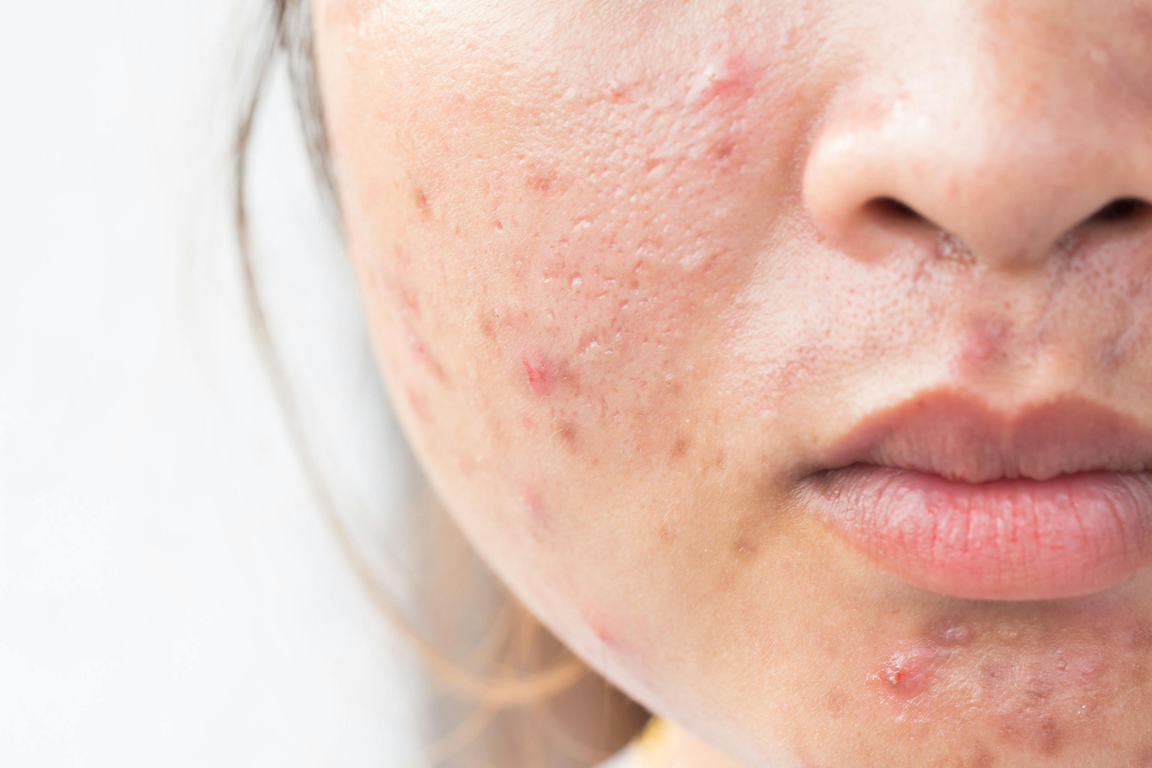 Study Investigates CBD as Acne and Acne Scar Treatment