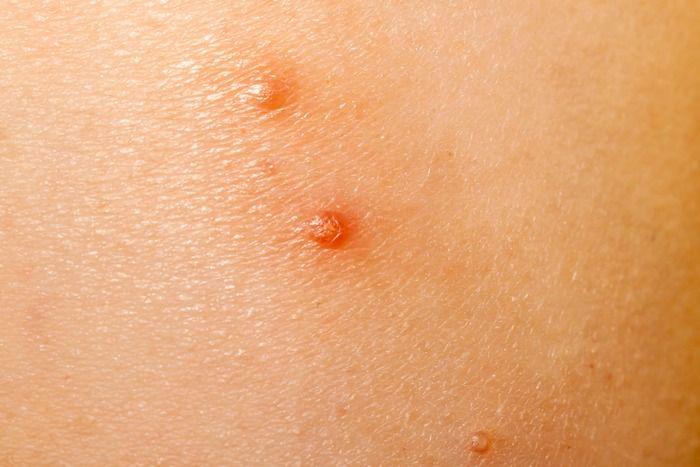 close up of 2 molluscum contagiosum lesions