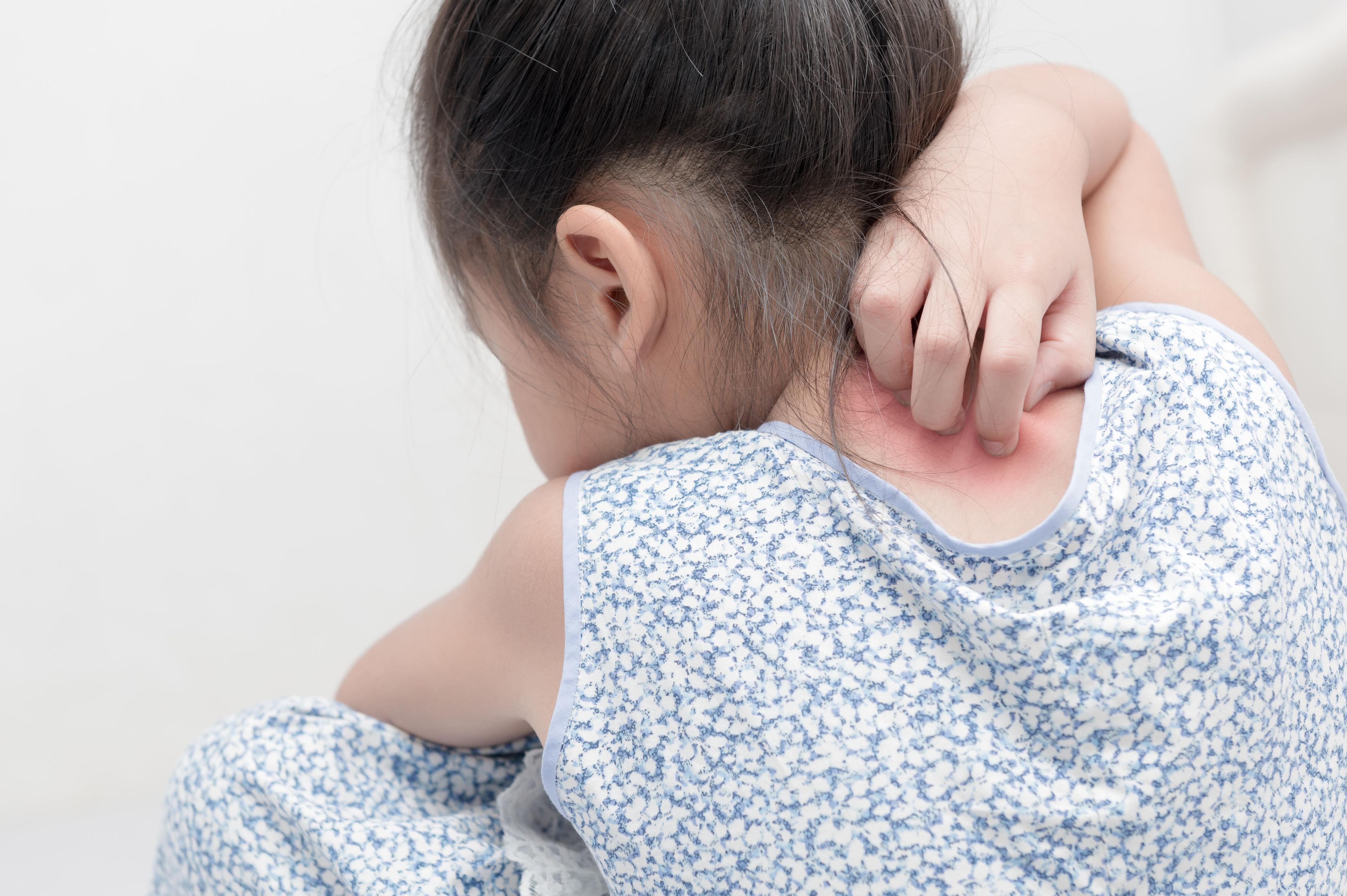 Child with psoriasis | Image Credit: © kwanchaichaiudom - stock.adobe.com