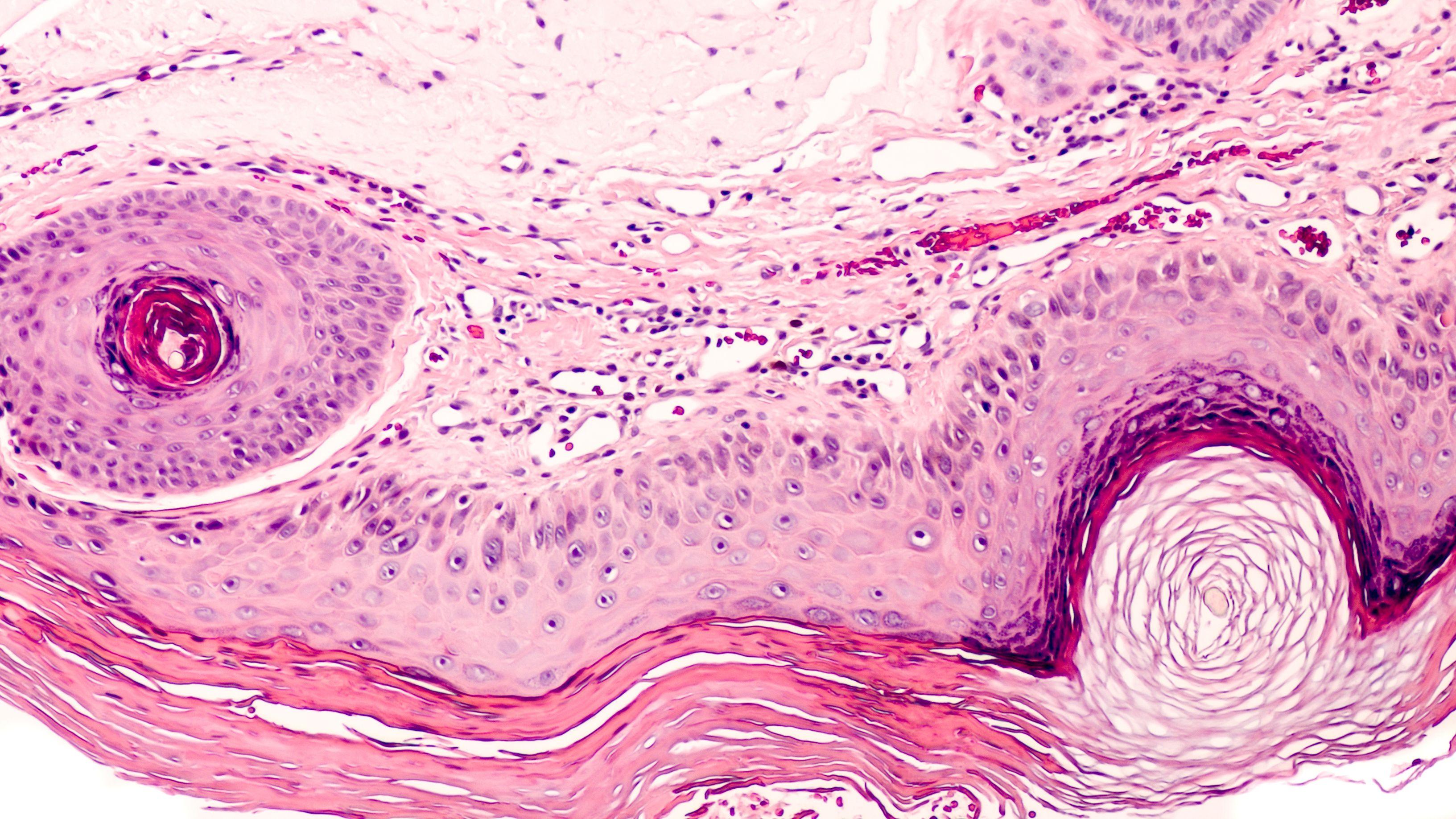 actinic keratosis