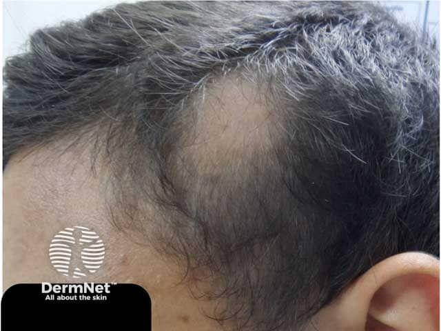 How Managing Comorbidities Can Transform Alopecia Areata Treatment Outcomes