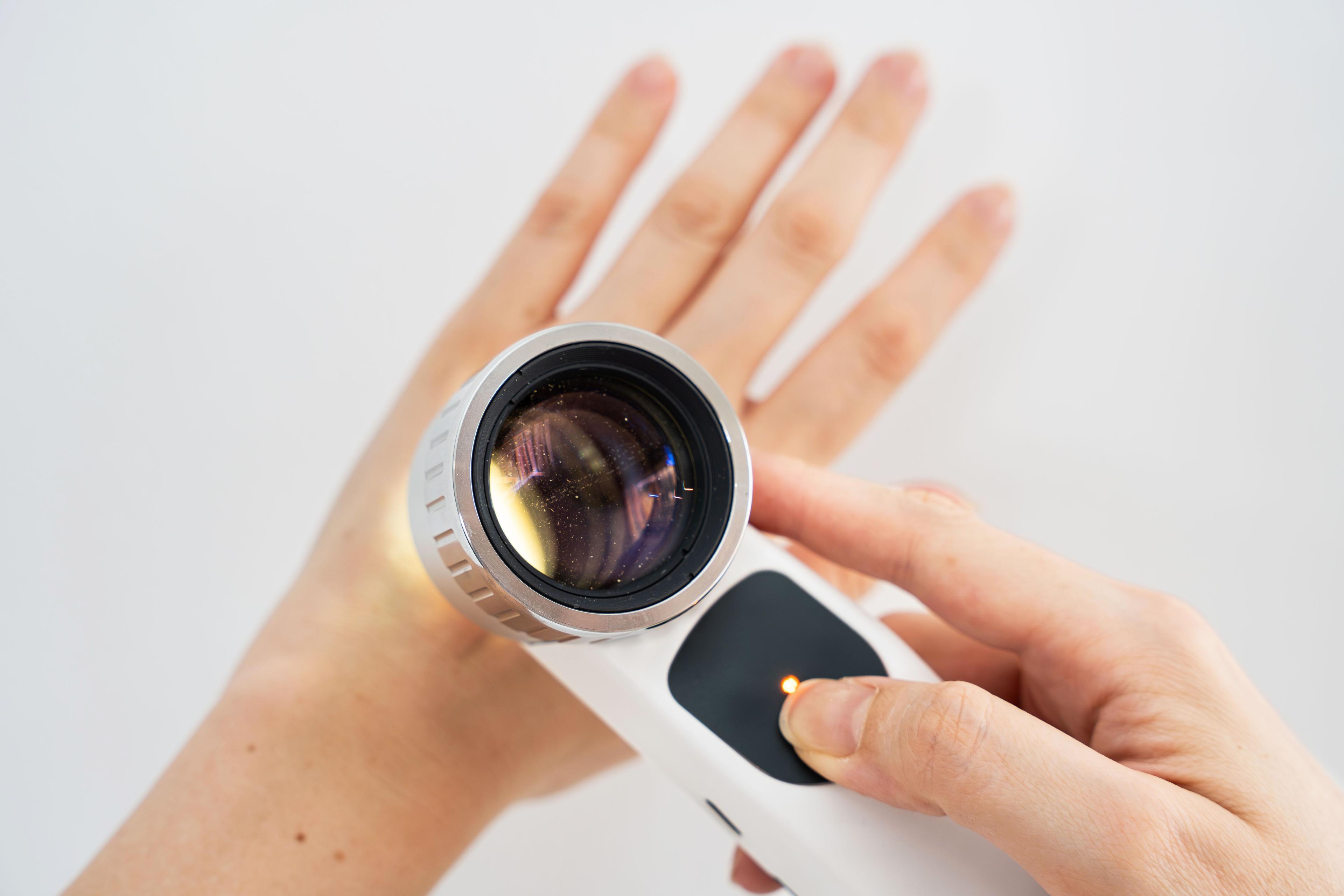 Hand holding and using a dermatoscope to examine nevi on the surface of a hand