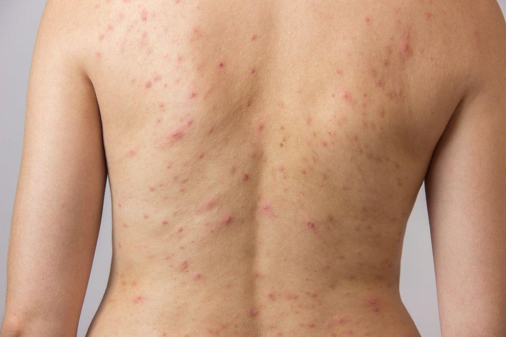 Acne on back