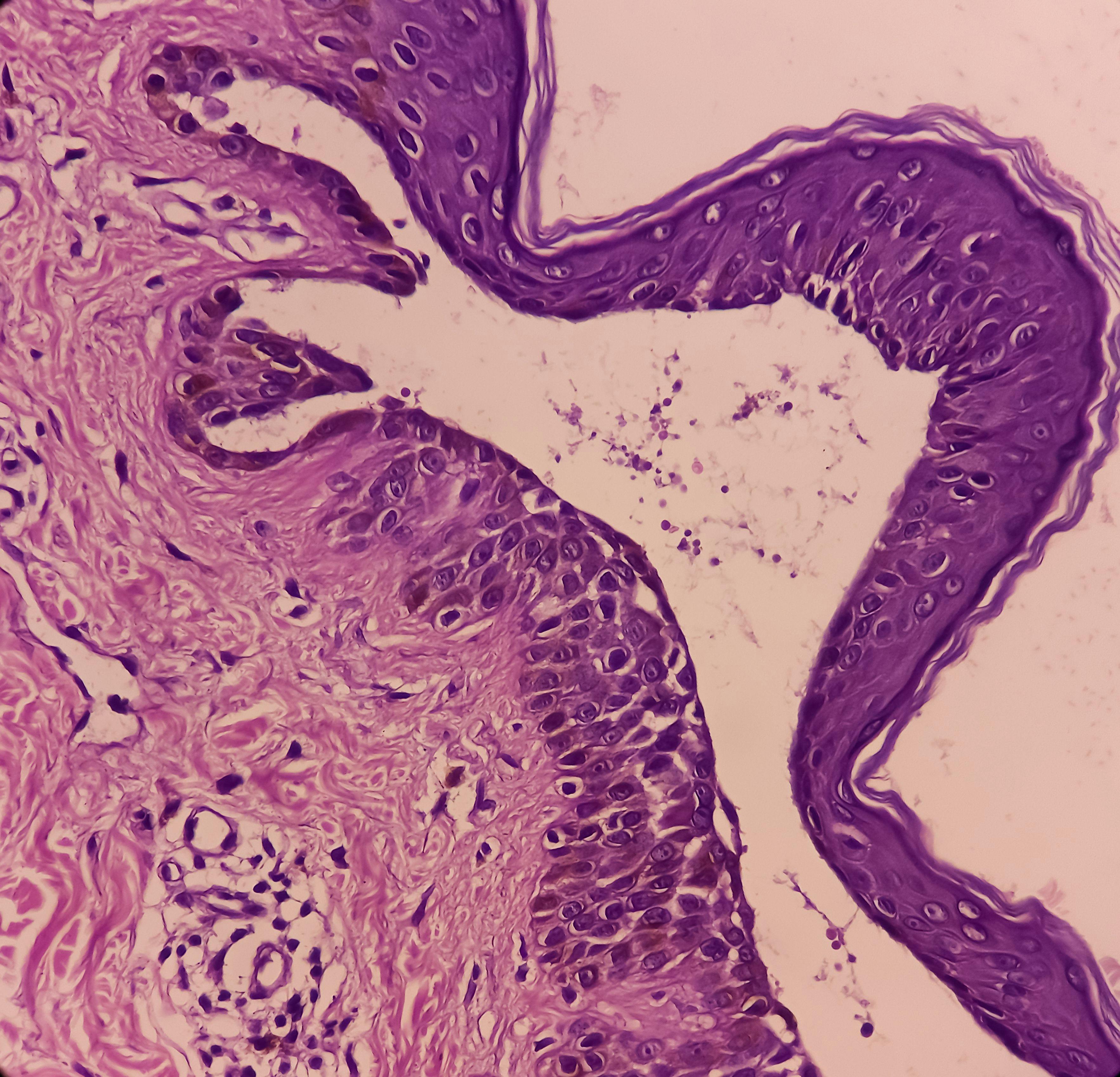 Patients With Pemphigus Vulgaris Given Rituximab did not Experience More Severe COVID-19