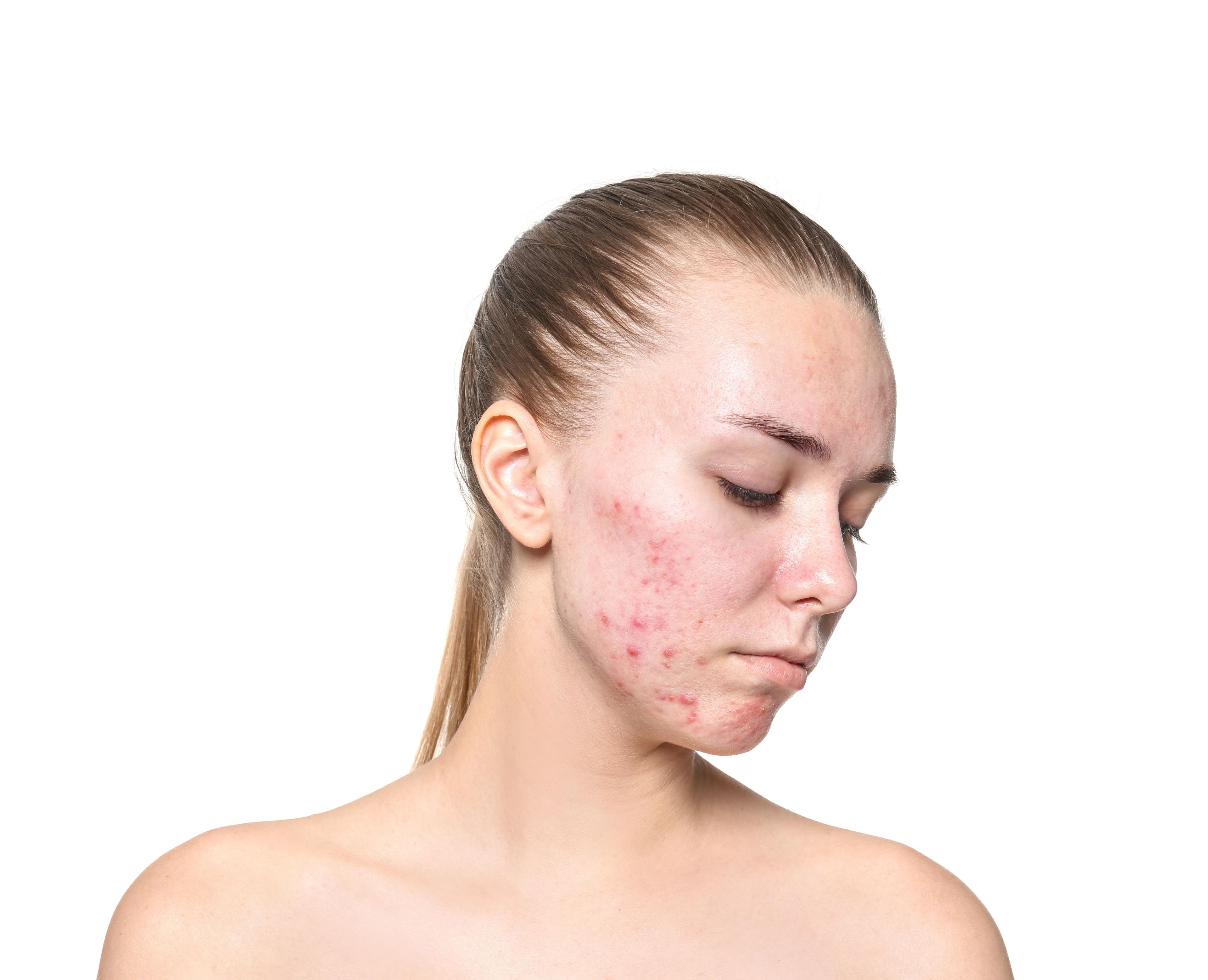 GLP-1 Agonists Not Linked to the Development of Acne 