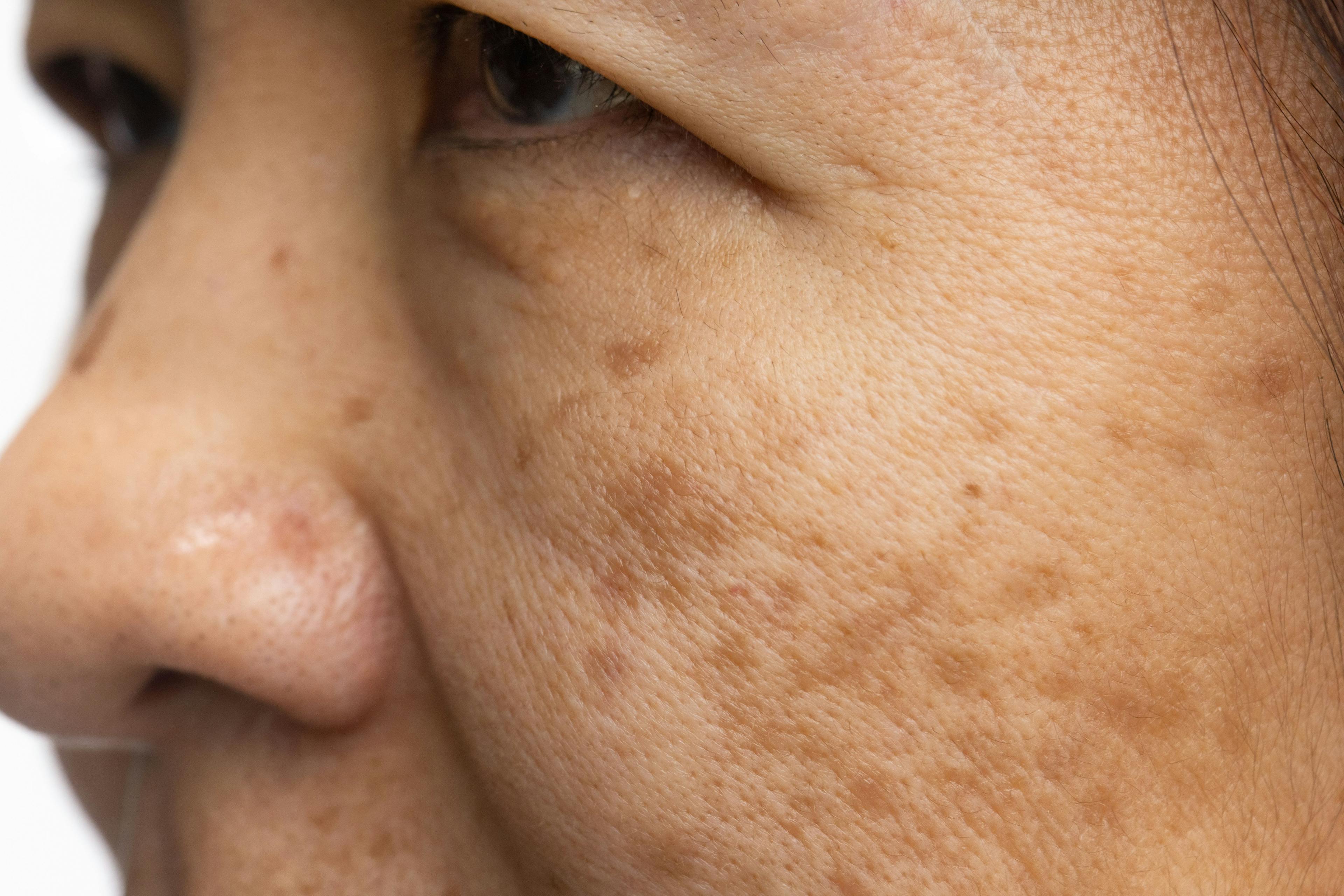 Patient with melasma | Image Credit: © toa555 - stock.adobe.com