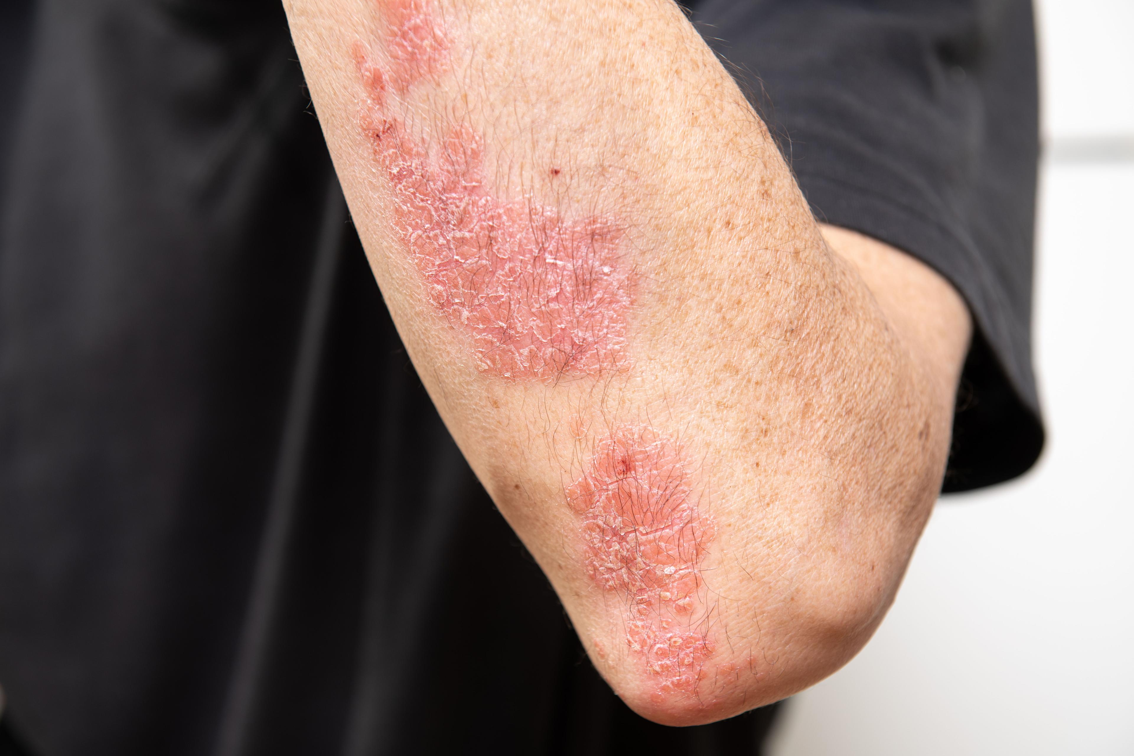 Patient with psoriasis on elbow | Image Credit: © pimentos - stock.adobe.com