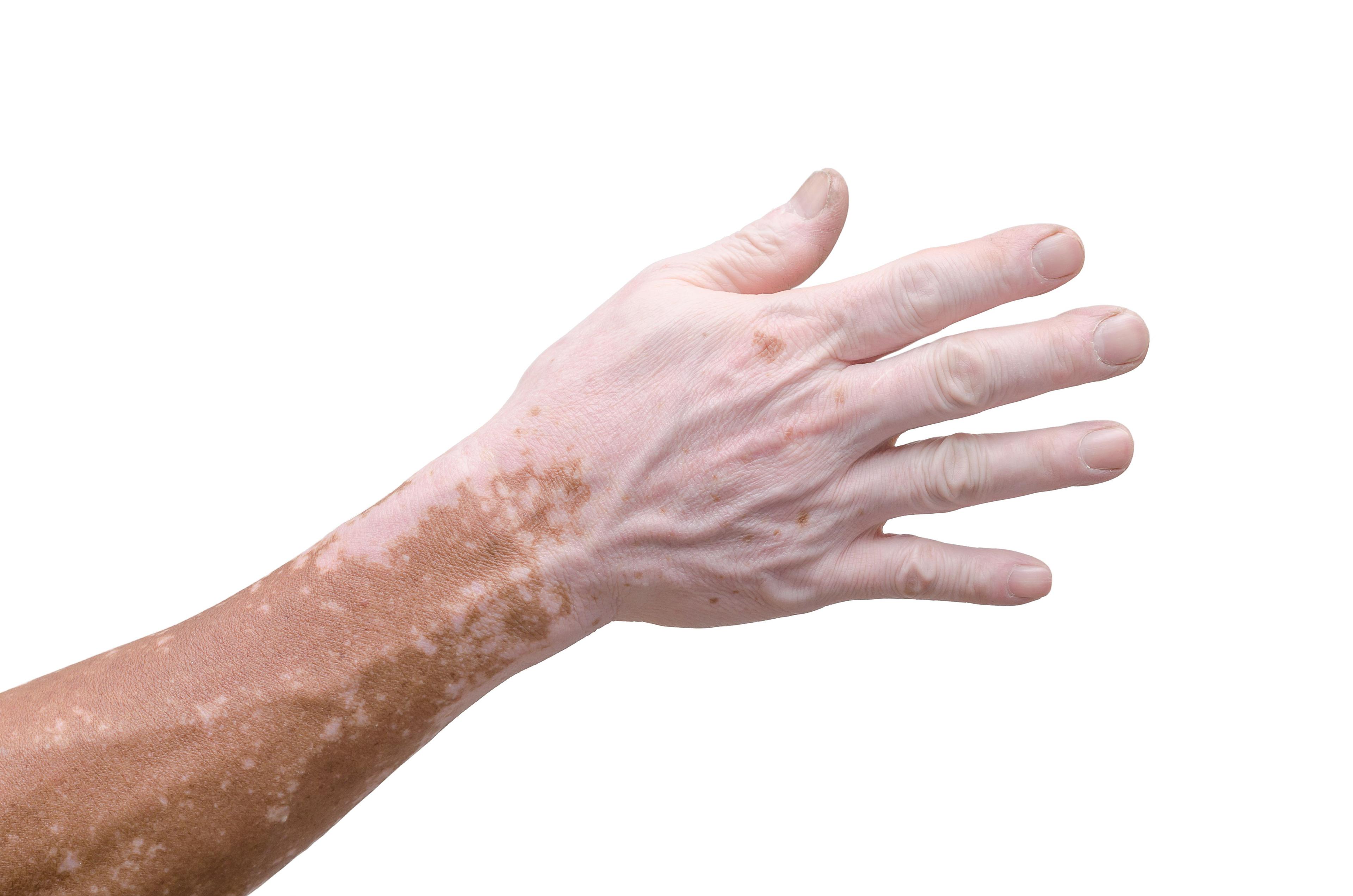 Vitiligo Risk Alleles Vary Across Different Populations, According to Study