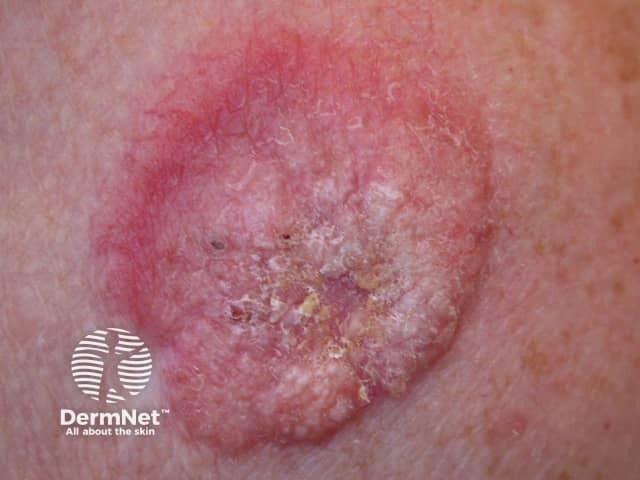 Basal cell carcinoma affecting the trunk | Image credit: DermNet