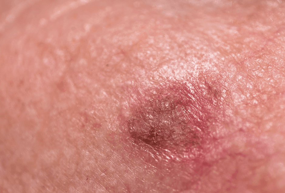 actinic keratoses