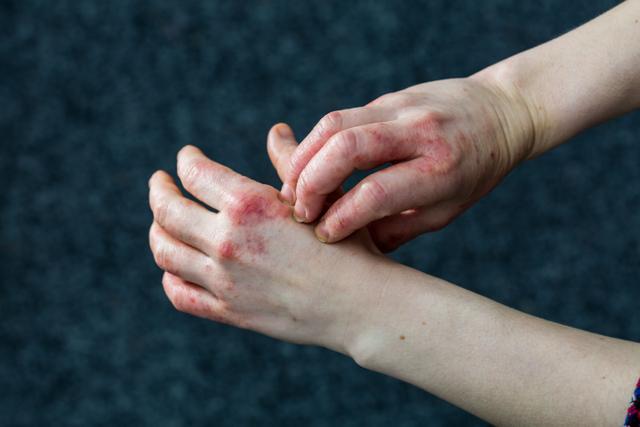 Chronic Hand Eczema and the Impact of Corticosteroid Fear