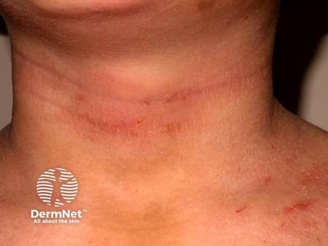 Patient with atopic dermatitis on neck | Image Credit: © DermNetz.org