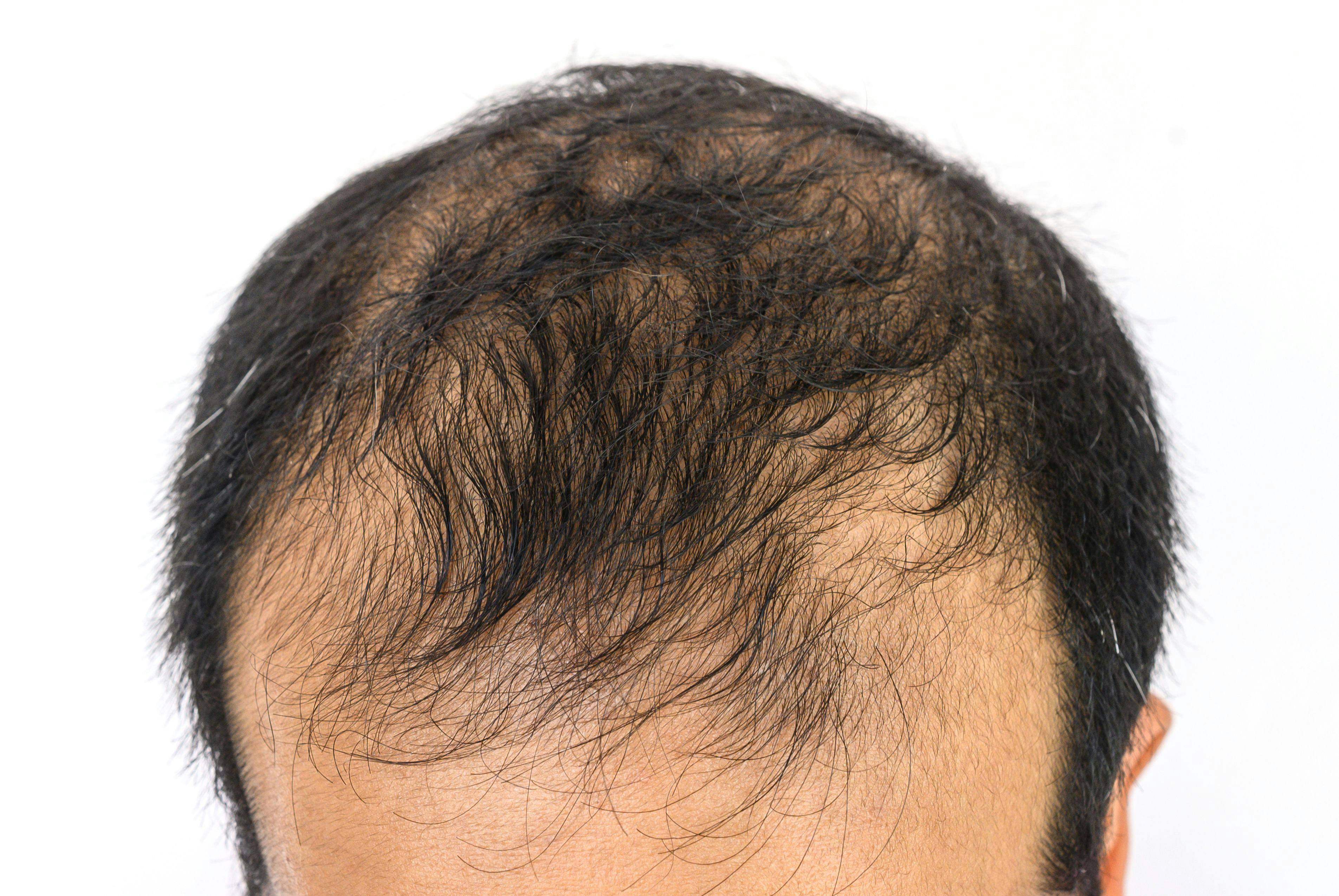 Close up of male-pattern baldness