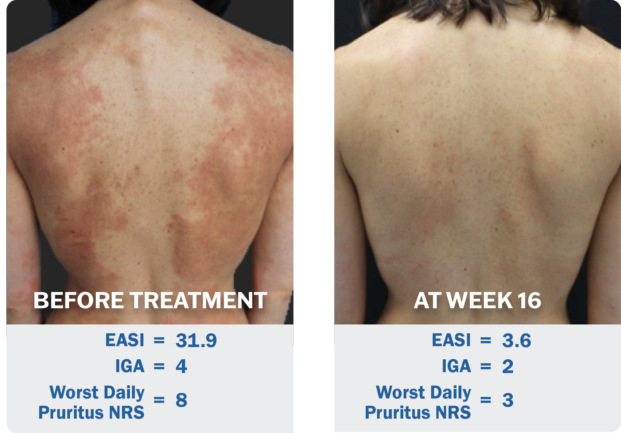 Example improvement in EASI from baseline to Week 16 in patient receiving Adbry in ECZTRA 2. Individual results may vary.