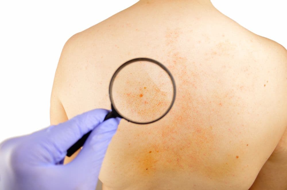 AAD updates melanoma treatment guidelines