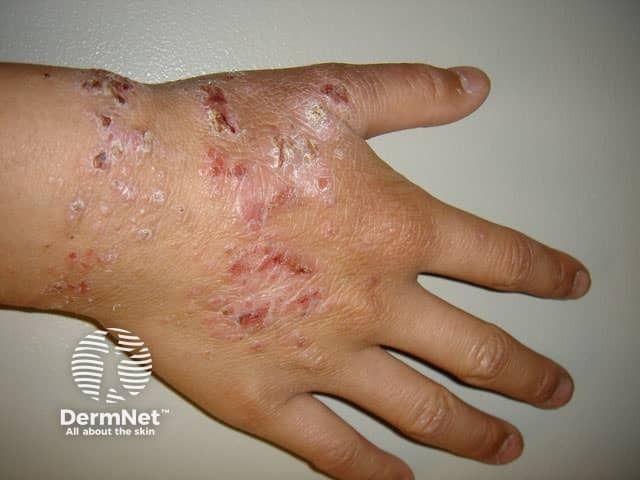 Hand atopic dermatitis | Image credit: DermNet