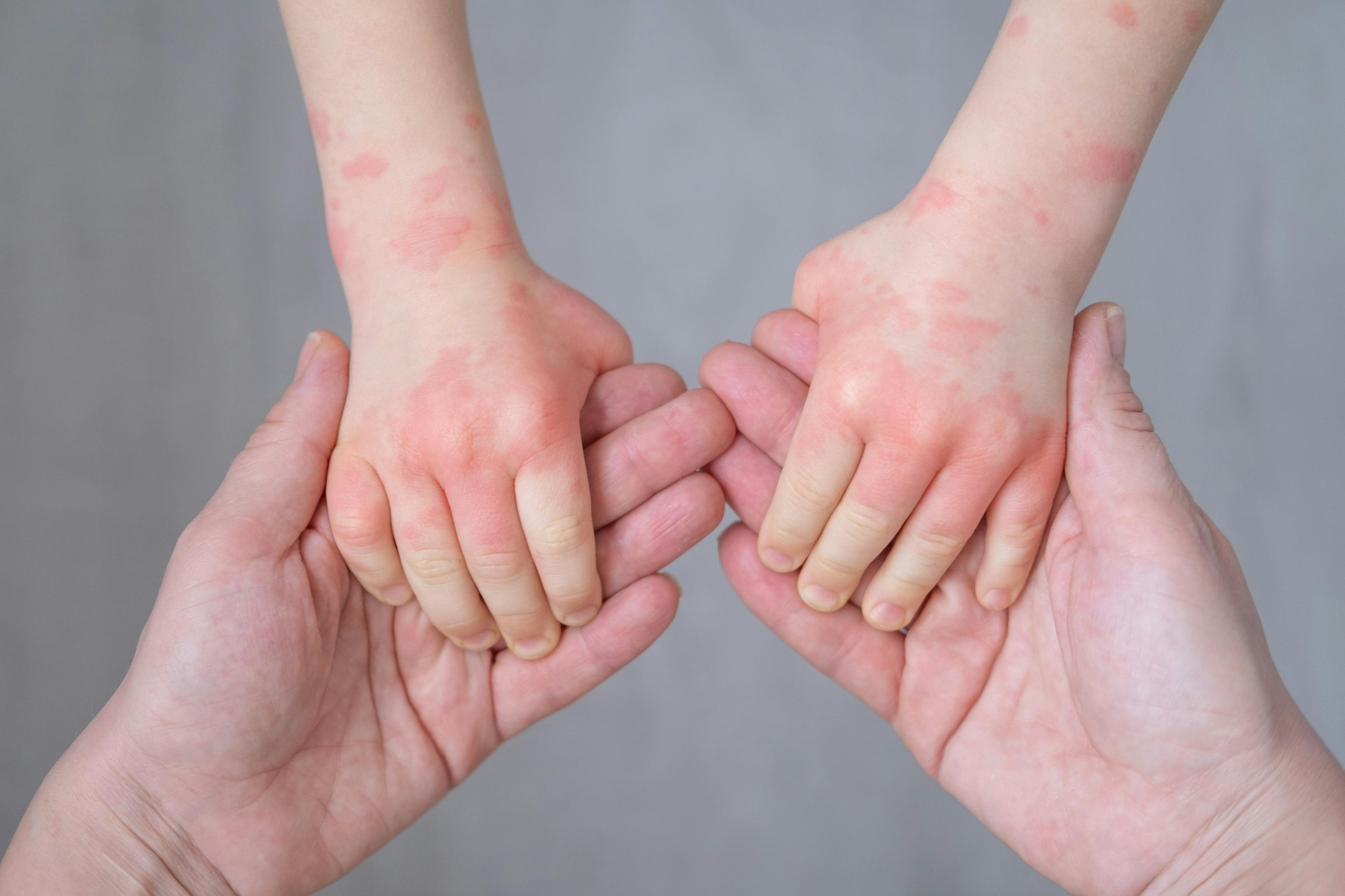 Top Secrets to Shield Your Patients From Eczema and Allergies 