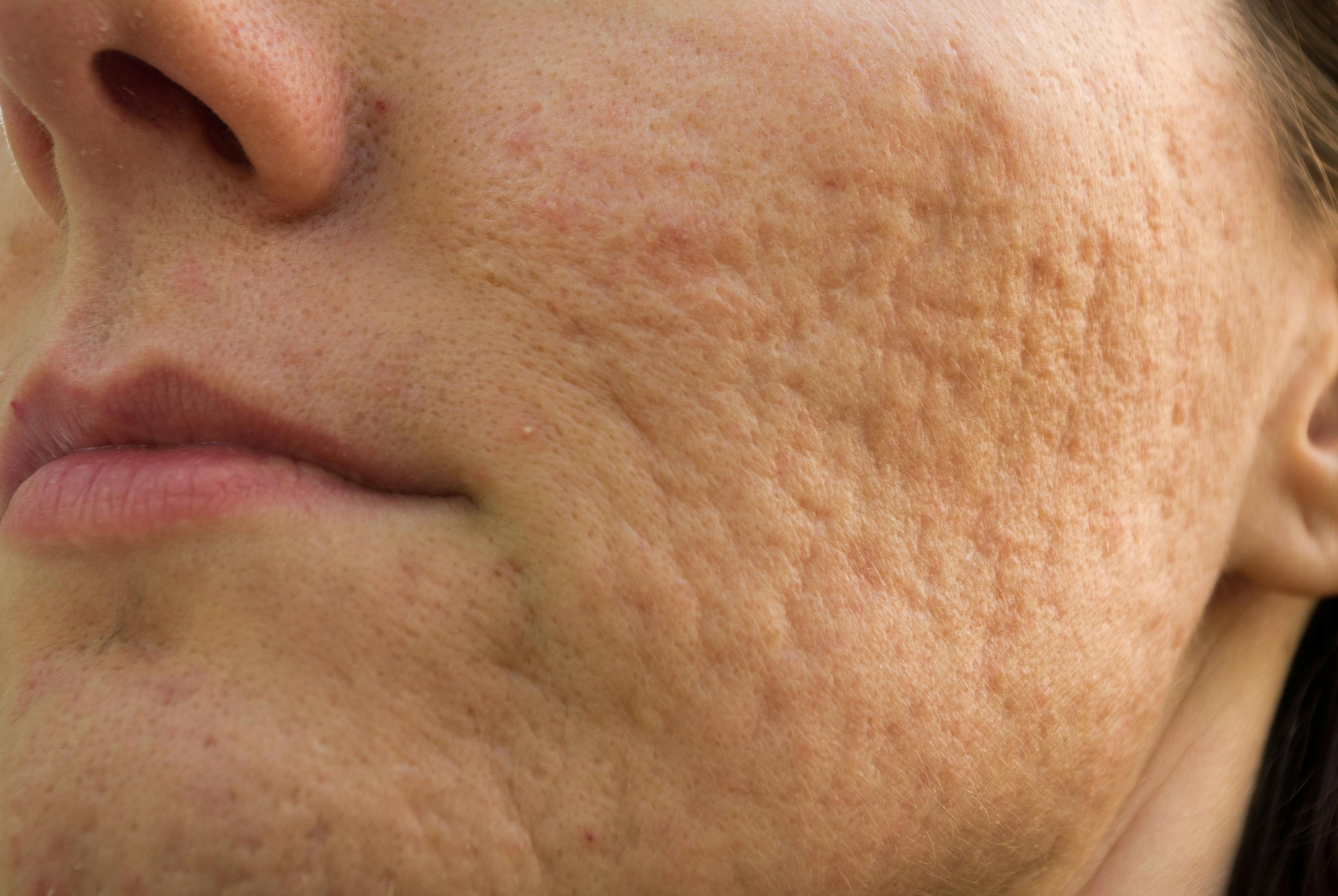 Acne scarring on the cheek