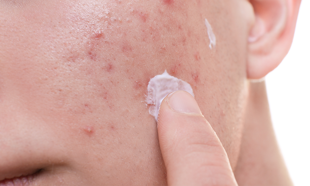 Acne cream seeks marketing authorizations in EU