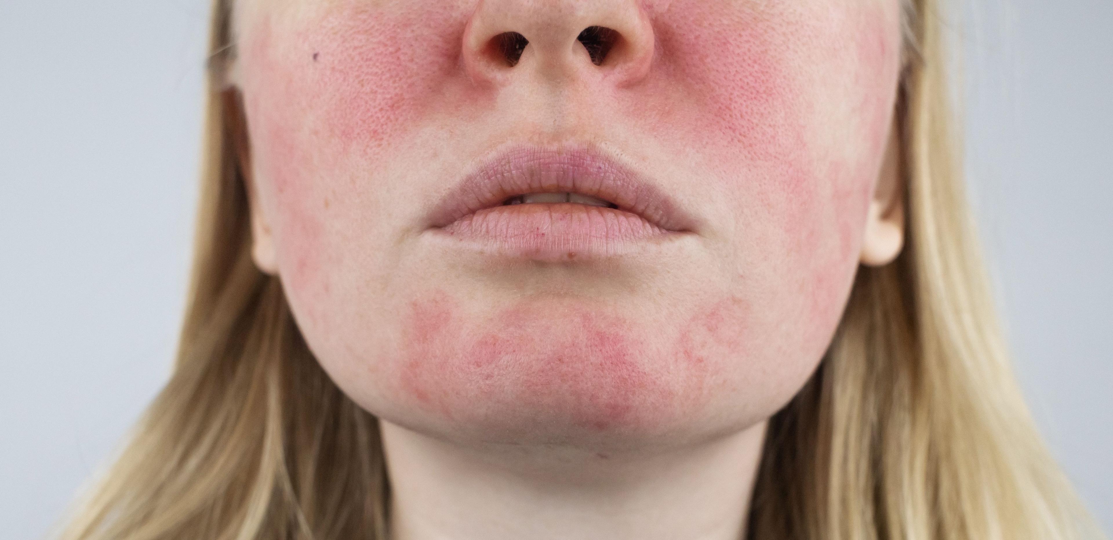 Patient with Rosacea | Image Credit: © Siniehina - stock.adobe.com