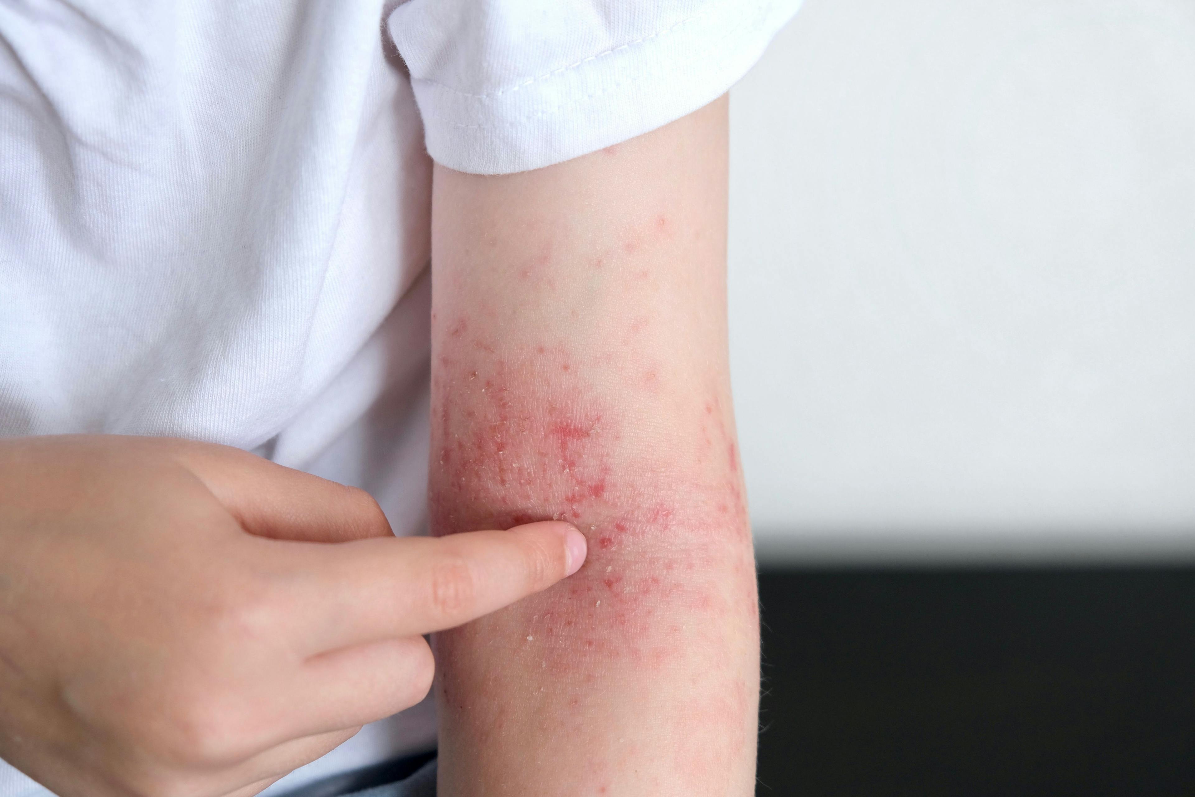 Managing Food Allergies with Dupilumab in Pediatric Dermatology