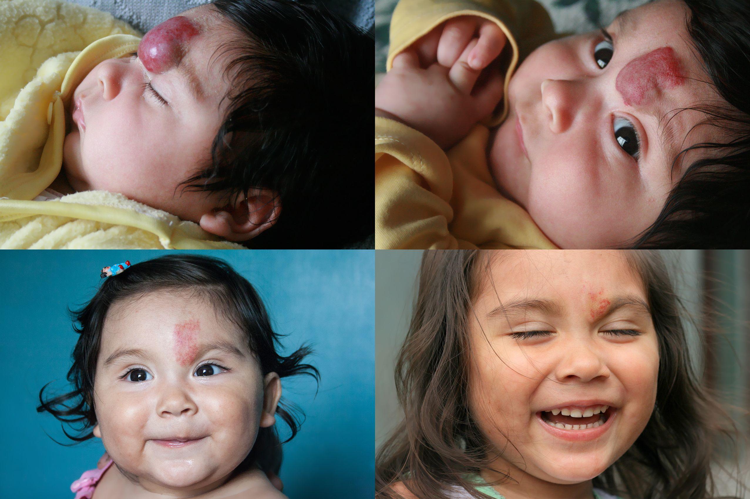 Distribution not random for localized infantile facial hemangiomas