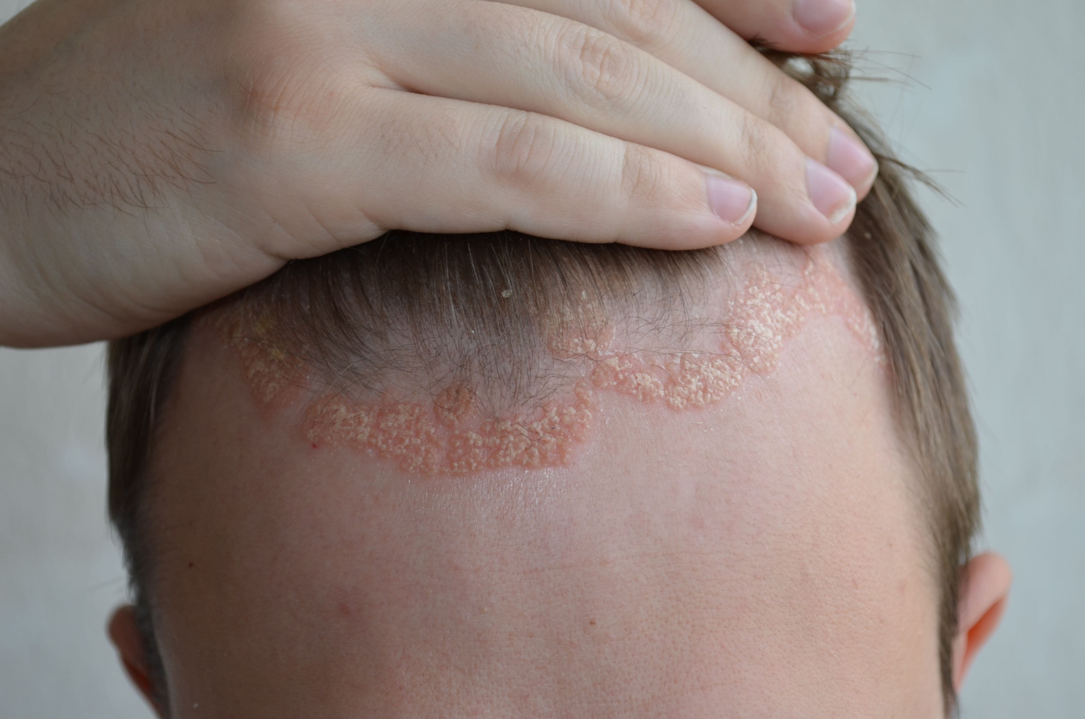 Psoriasis of the scalp