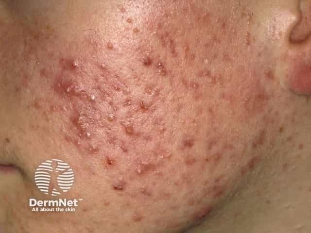 Patient with acne | Image Credit: © DermNet