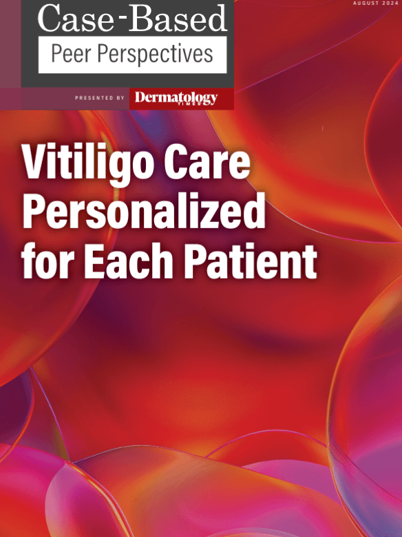 Vitiligo Care Personalized for Each Patient: Part 4