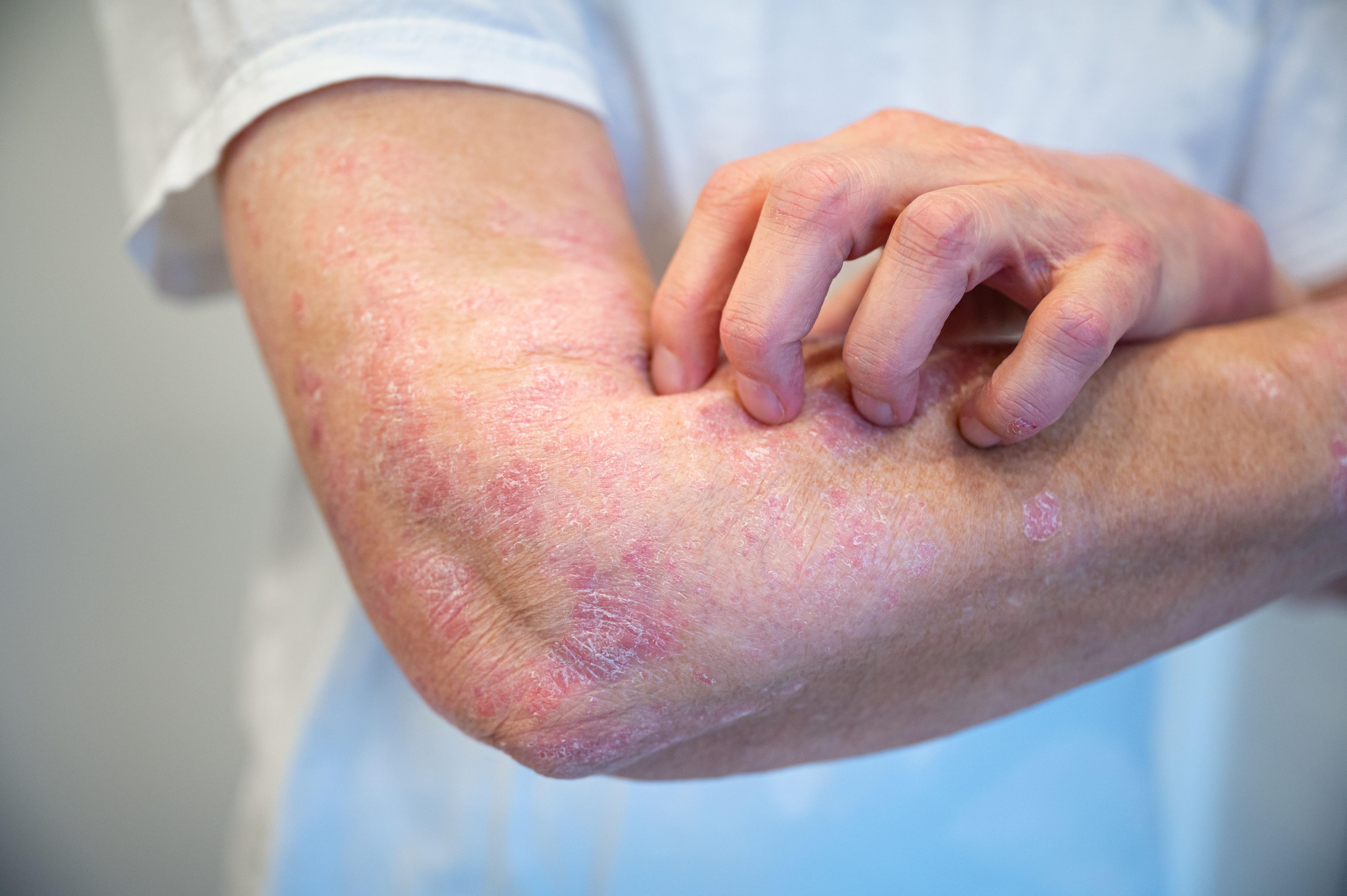 Elderly patient with psoriasis | Image Credit: © Daniel Beckemeier - stock.adobe.com