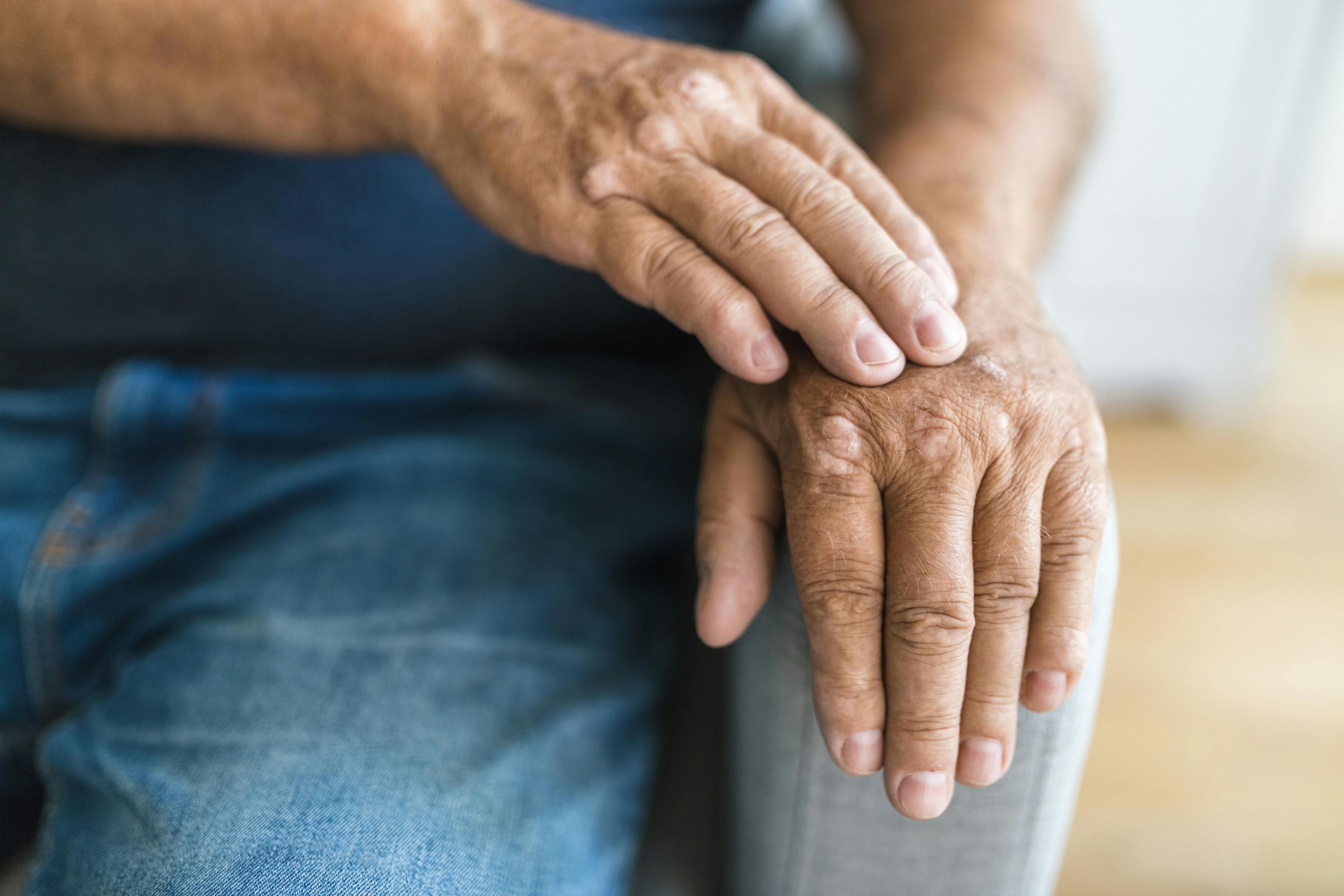 Patient with Psoriatic Arthritis | Image Credit: © and.one - stock.adobe.com