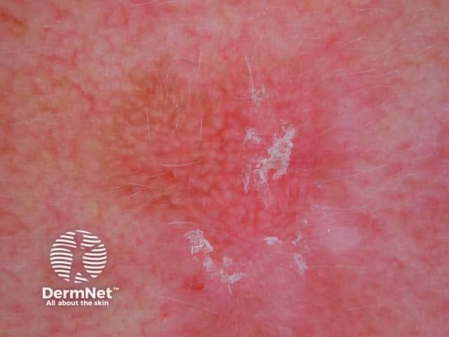 Patients Report Higher Treatment Satisfaction With Surgery Versus Other Actinic Keratosis Therapies