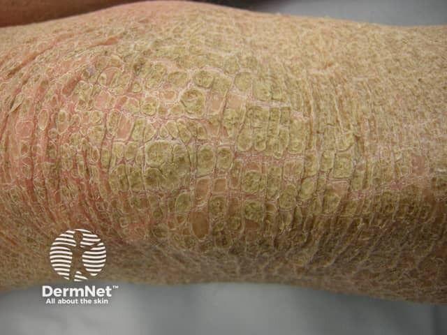 Ichthyosis | Image credit: DermNet