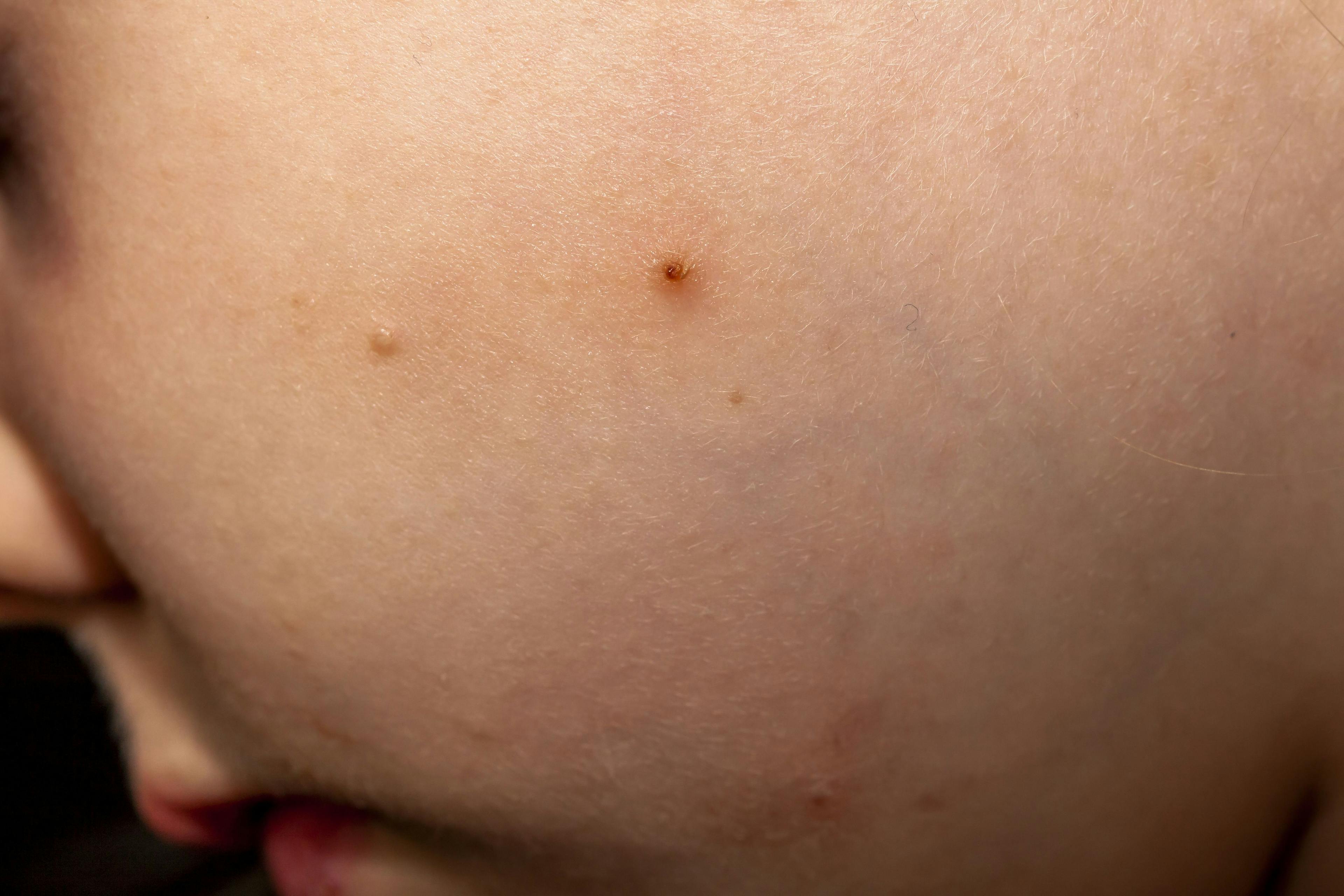 molluscum contagiosum 