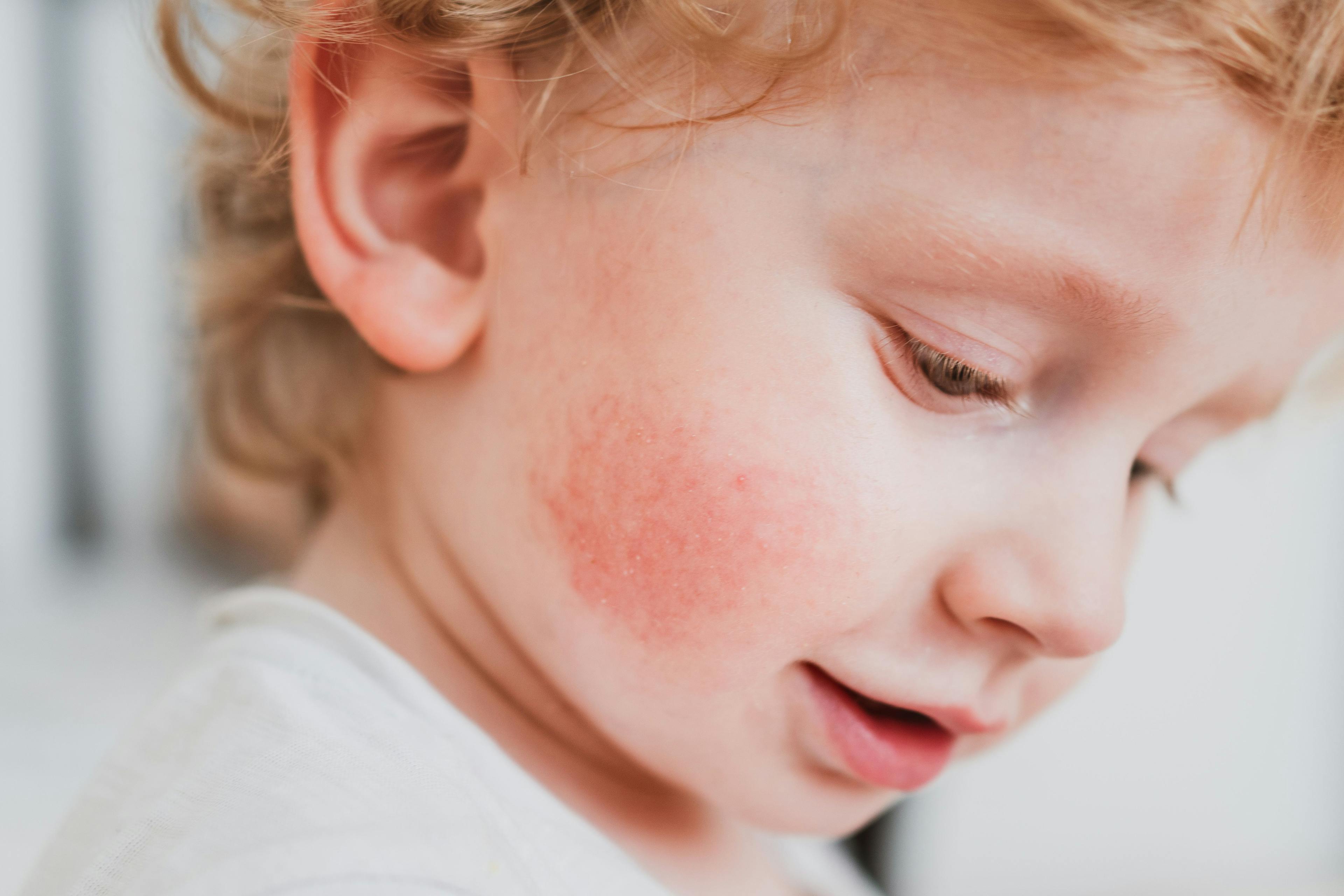 Prenatal Antibiotic Use Increases Risk of Childhood Atopic Dermatitis