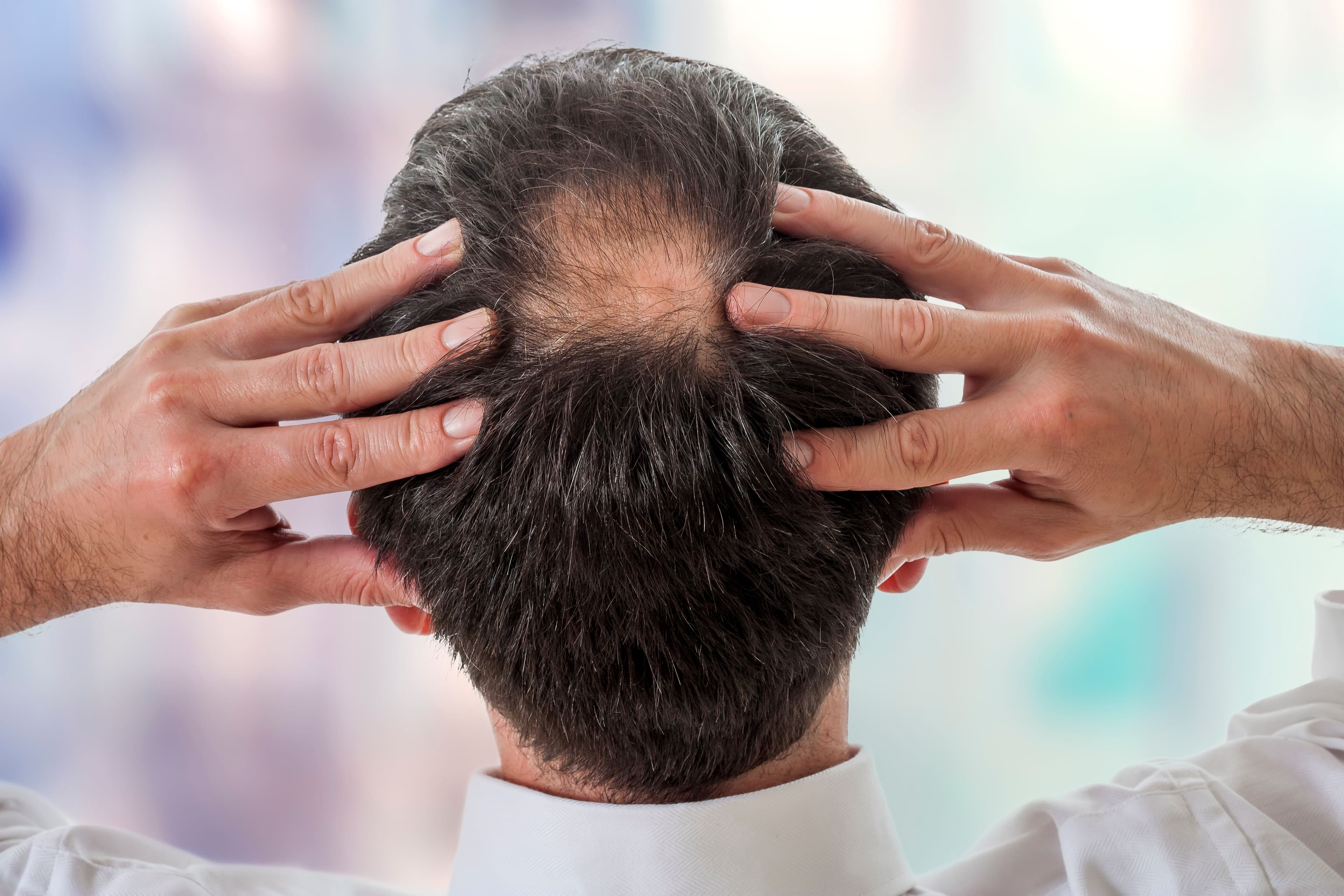 Brepocitinib Shows Promising Results for Treatment of Cicatricial Alopecia