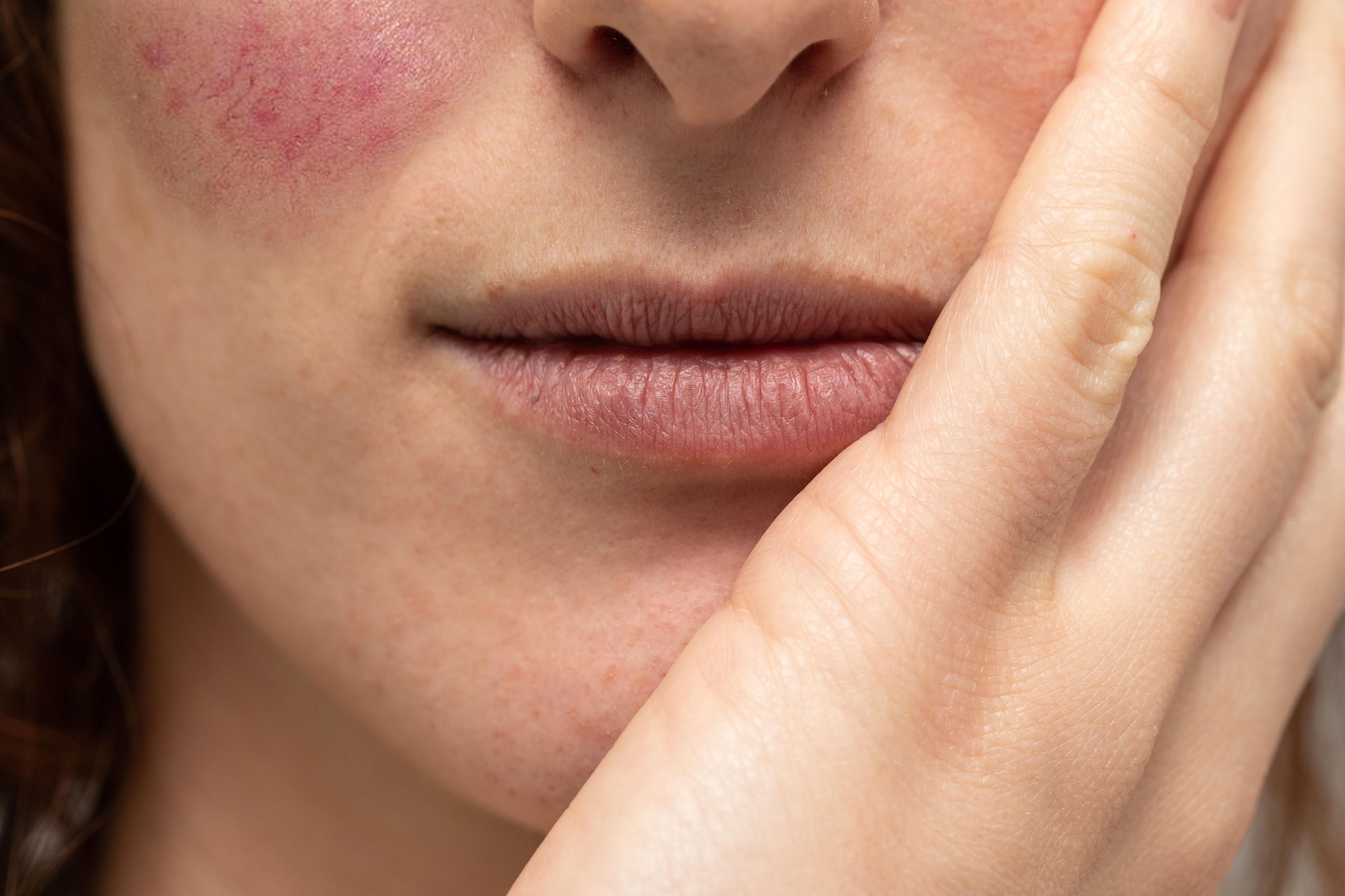 Patient with rosacea on cheeks | Image Credit: ©Alessandro Grandini - stock.adobe.com